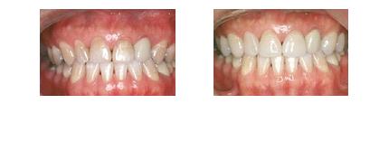 carillas_dentales